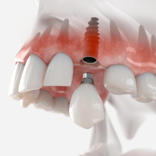 Dental Implants in Muskogee, OK
